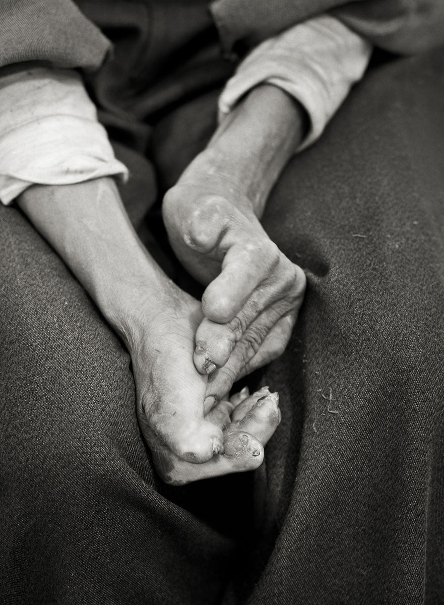 Leprosy VI