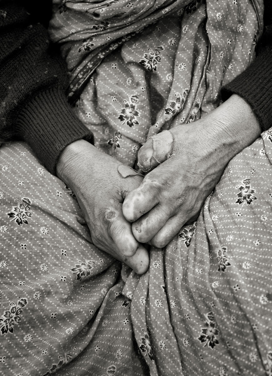 Leprosy VIII