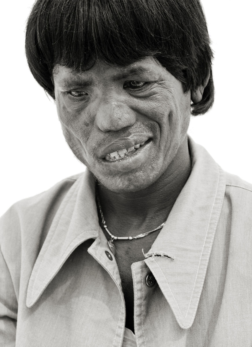 Leprosy XII